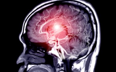 ¿Cómo se diagnostica un aneurisma? Claves para detectarlo a tiempo