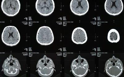 ¿Qué es la radiología intervencionista y cómo puede ayudarte?